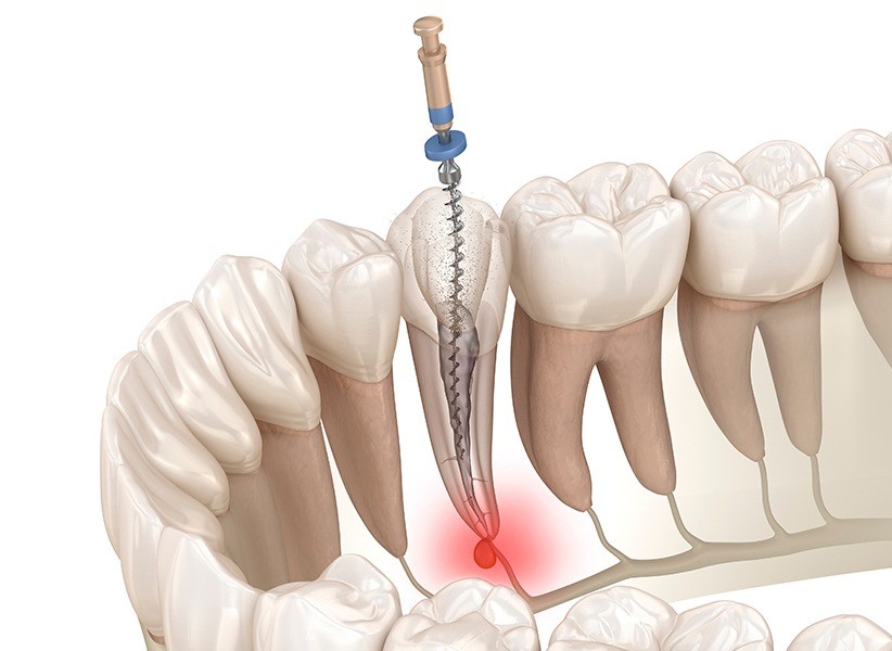 Endodonzia